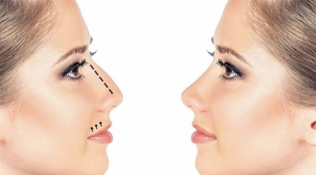 Top Tips You Need to Know When Recovering from a Nose Job