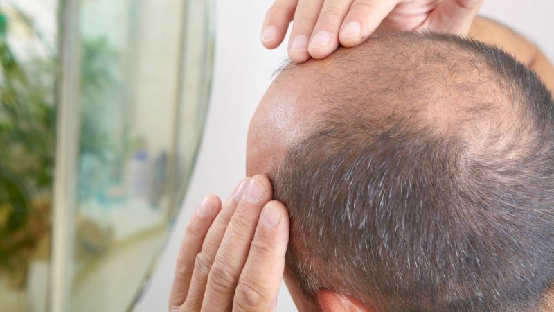 The effective and quick way of hair transplant to get hair again
