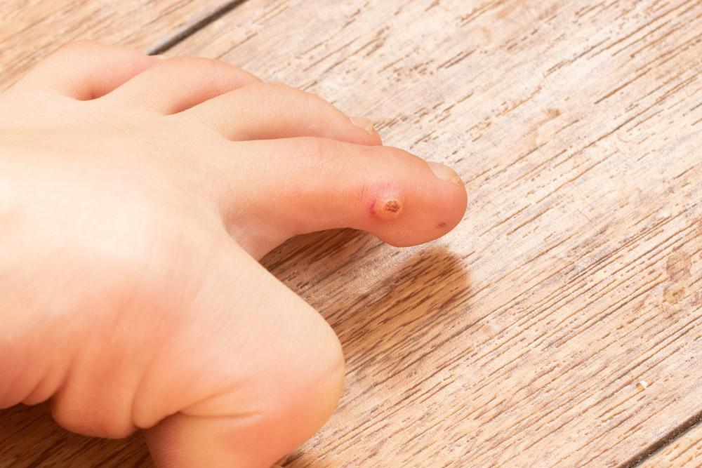 Everything you need to know about warts in humans.