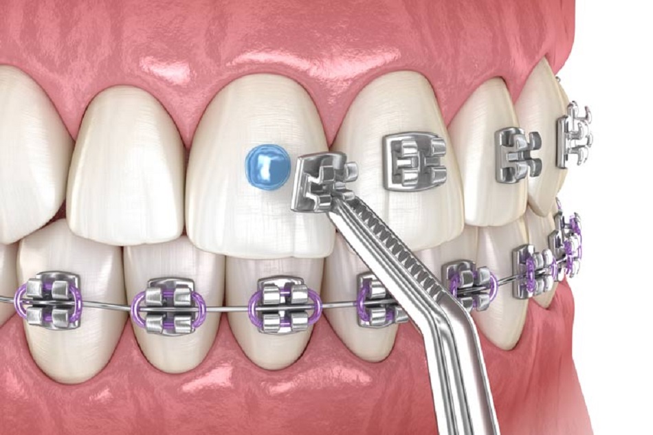 What are dental braces?