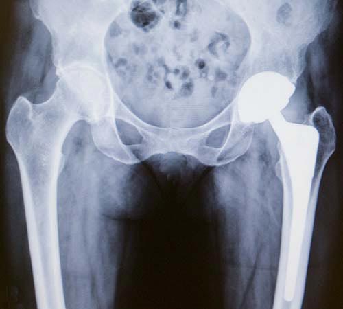 Is Hip Replacement Considered a High-Risk Surgery?