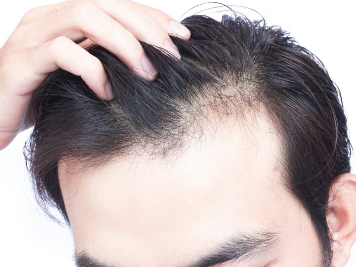 Hair loss- How can it affect people?