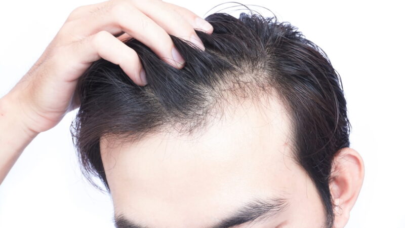 Hair loss- How can it affect people?