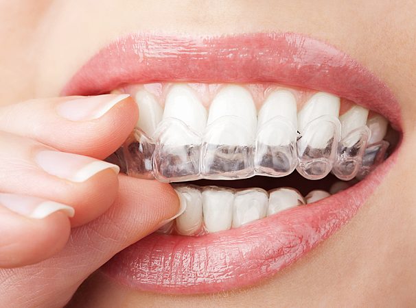 Visiting a dentist in Tukwila for teeth whitening: Know more here