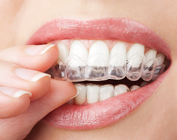 Visiting a dentist in Tukwila for teeth whitening: Know more here