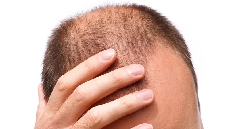 Early Signs of Male Pattern Baldness in Houston and When to Act